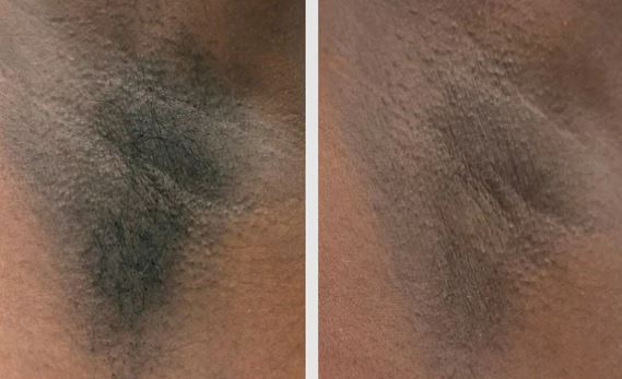 Épilation laser diode DermRays V6S, 1064 nm, spécialement conçue pour les peaux foncées