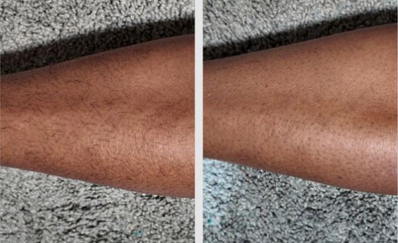 Épilation laser diode DermRays V6S, 1064 nm, spécialement conçue pour les peaux foncées